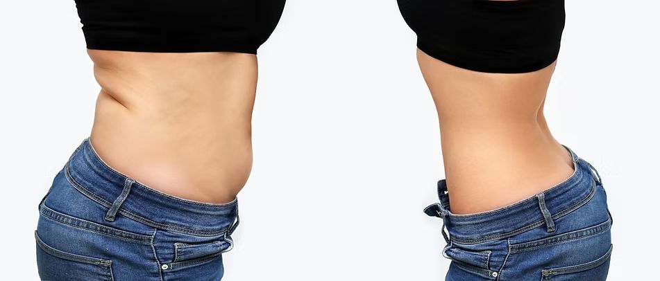 Post Bariatric image
