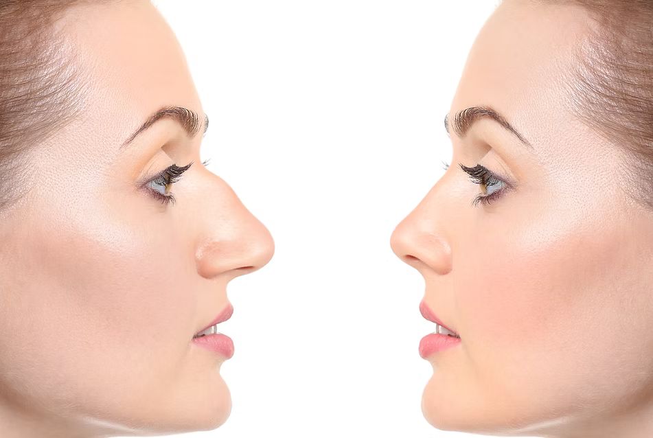 Rhinoplasty Image