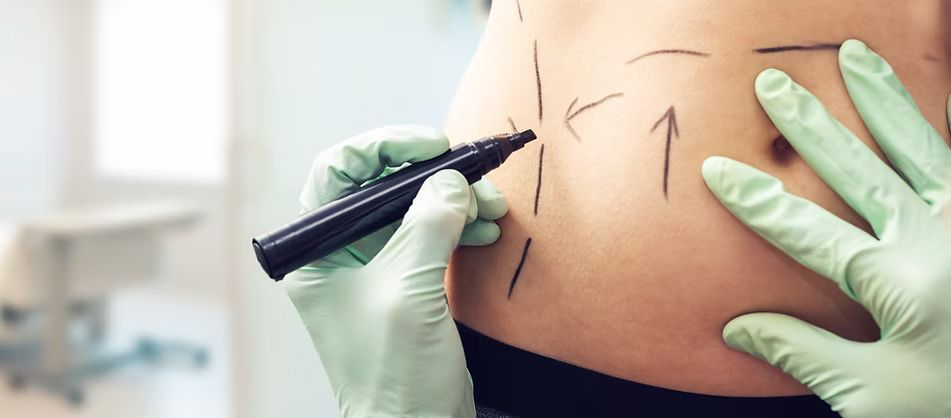 Smart lipo image