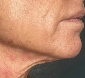 1 InnovativeBeauty Neck After