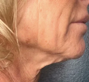 1 InnovativeBeauty Neck Before